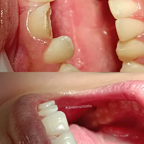 Dentística & Resinas