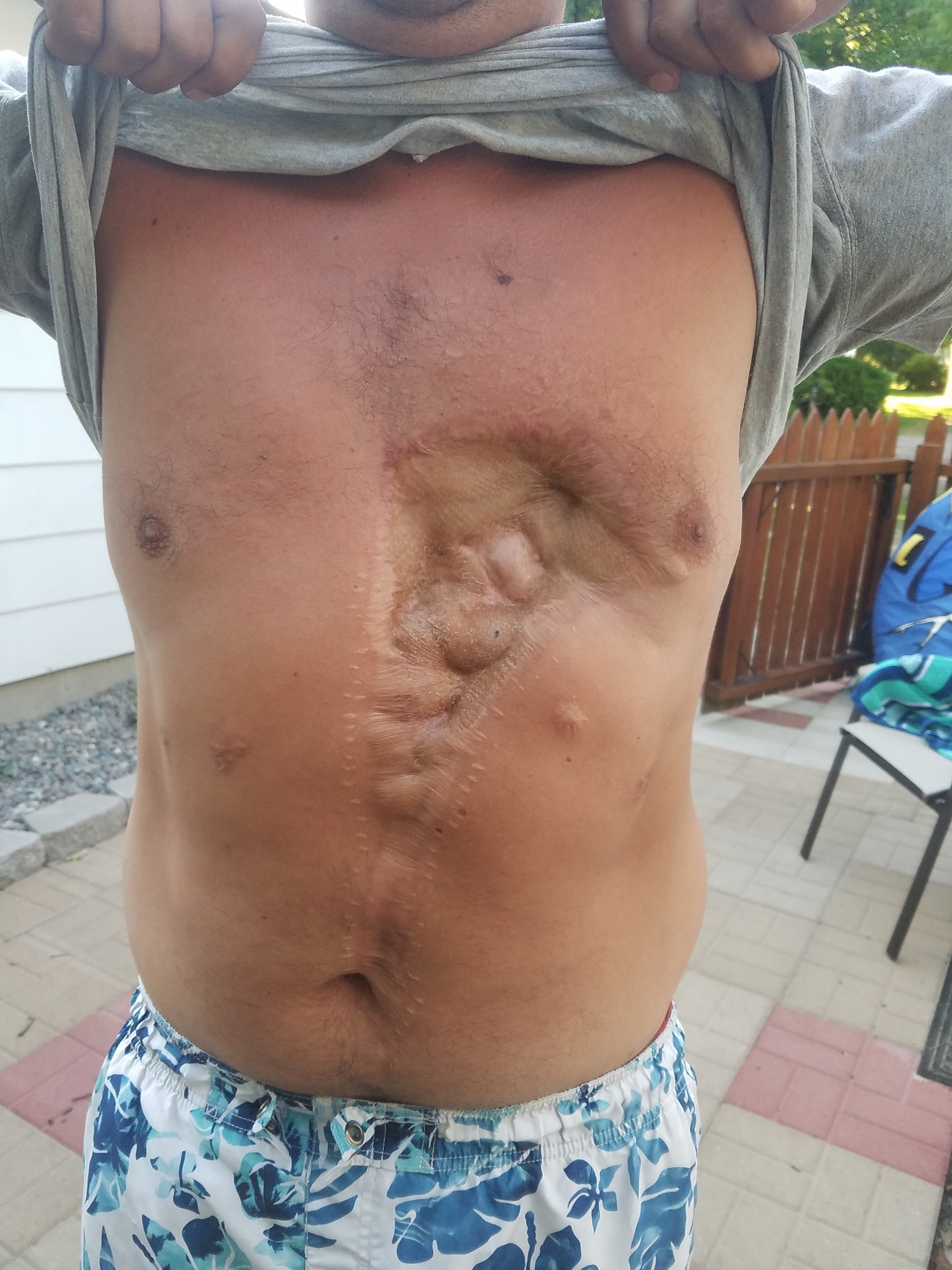Nick Beheng fireworks chest injury