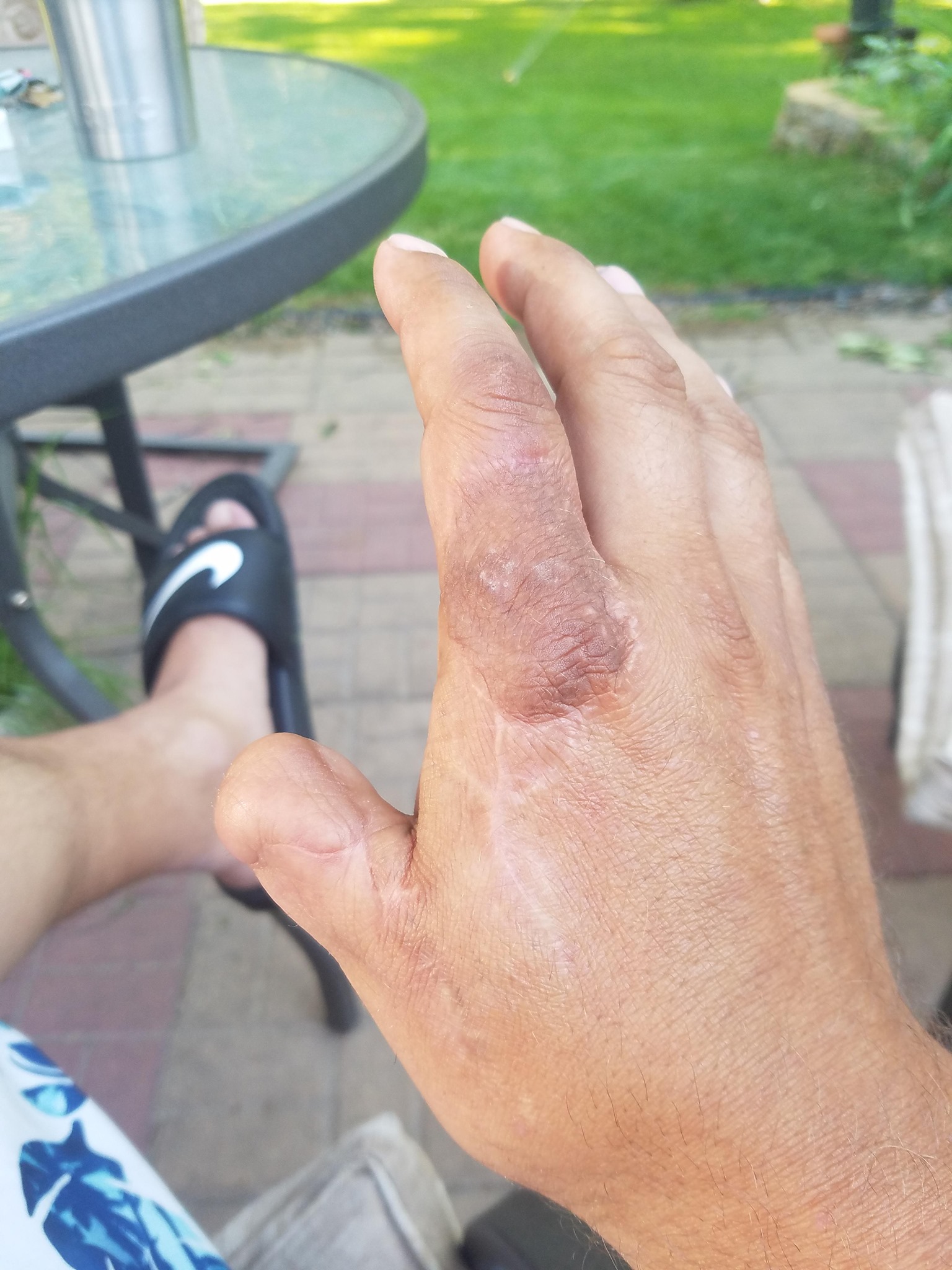 Nick Beheng fireworks hand injury