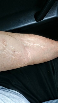 Mederma Lotion Stretch Marks