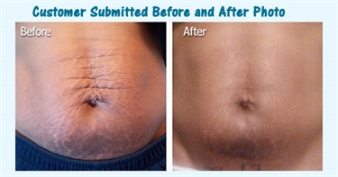 Rodan Fields Stretch Marks