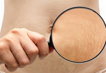 New White Stretch Marks