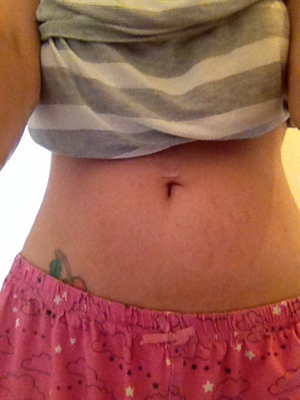 Stretch Marks On Face Pictures