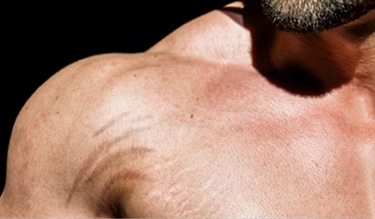 Stretch Marks Micro Needling