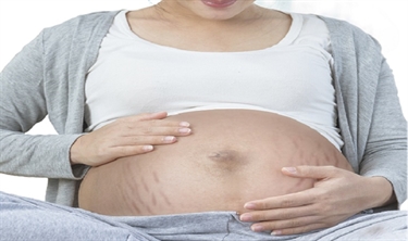 Essential Oil For Stretch Marks