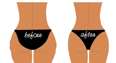 Stretch Mark Removal Machine