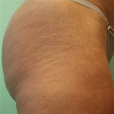 Homemade Lotion For Stretch Marks