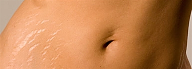 Mama Mio Stretch Mark