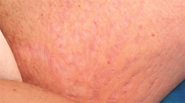 Stretch Marks Breasts