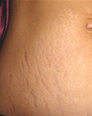 Stretch Mark Removal For Men