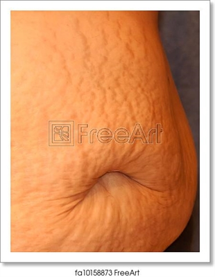 Stretch Mark And Cellulite