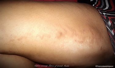 Stretch Marks In Teenage Female