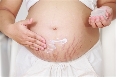 How To Prevent Stretch Marks Working Out