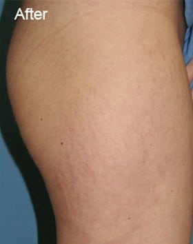 Stretch Marks Photos