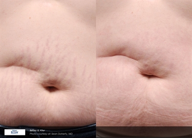 Vicks Rub For Stretch Marks