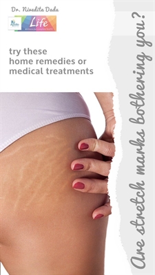 Maderma Stretch Mark
