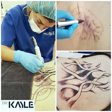 Laser Stretch Mark Removal Nyc Cost