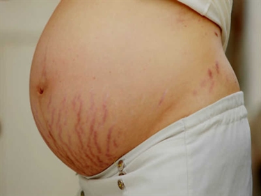 Stretch Marks Or Varicose Veins