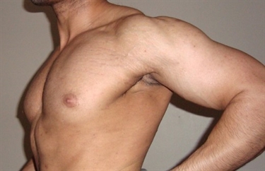 Photos Of Stretch Marks