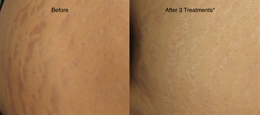 Stretch Mark Removal San Diego
