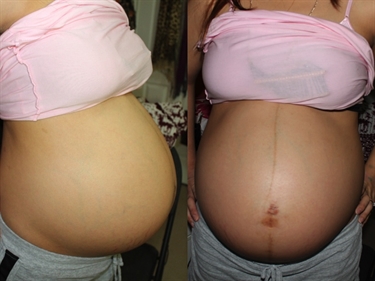 Does Vaseline Help Stretch Marks