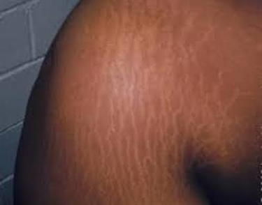 Palmers Cream Stretch Marks