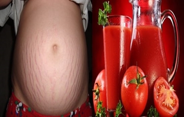 Microdermabrasion Kit For Stretch Marks