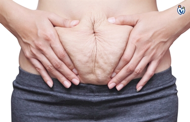 Six Pack Stretch Marks