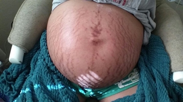 What Does Cocoa Butter Do For Stretch Marks