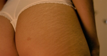 Best Lotion To Get Rid Of Stretch Marks