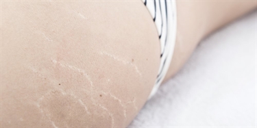 Does Fake Tan Cover Stretch Marks