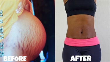 Laser Removal Of Stretch Marks Cost