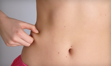 Will Mederma Work On Stretch Marks