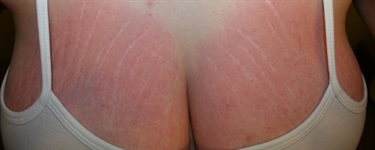 Stomach Tattoos To Cover Stretch Marks