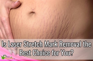 Derma Roller On Stretch Marks