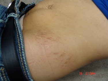 Does Vix Help With Stretch Marks