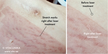 Lazer Stretch Mark Removal