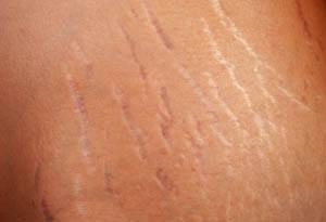 Stretch Mark Removal Tampa