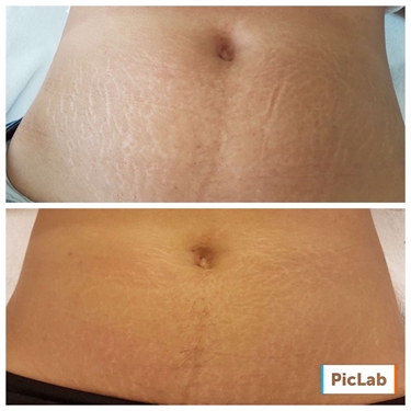 Kate Hudson Stretch Marks