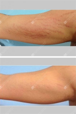 Product To Remove Stretch Marks