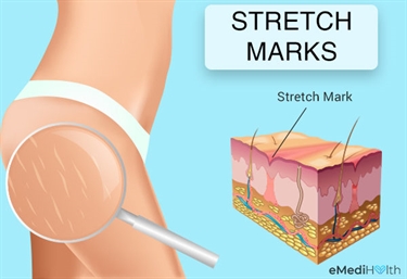 Stretch Marks Exfoliate