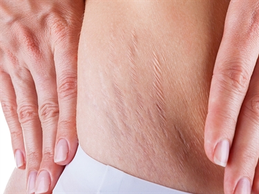 Tea Tree Oil Stretch Marks