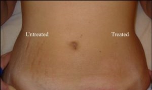 Tattoos And Stretch Marks