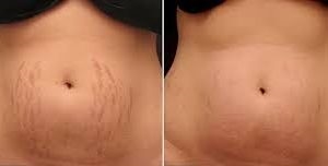 Fit Bodies With Stretch Marks