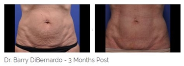 How To Get Rid Of Stretch Marks Reddit
