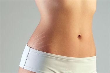 How To Get Rid Of Stretch Marks Men