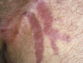 Stretch Mark Forums