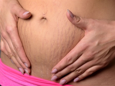 Covering Stretch Marks
