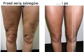 Micropen For Stretch Marks