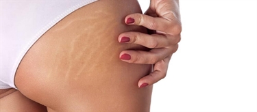 Stretch Marks Itch